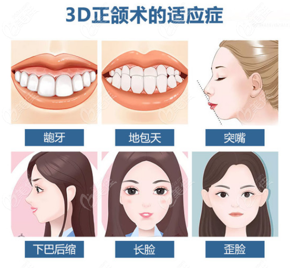 广州骨性龅牙手术医院排名