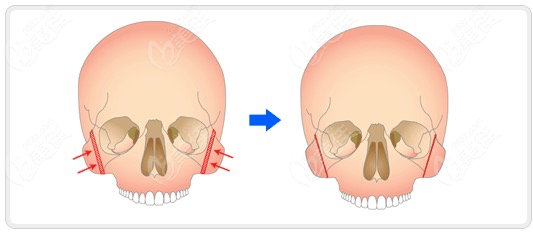 顴骨內(nèi)推二次修復(fù)為什么難度更大