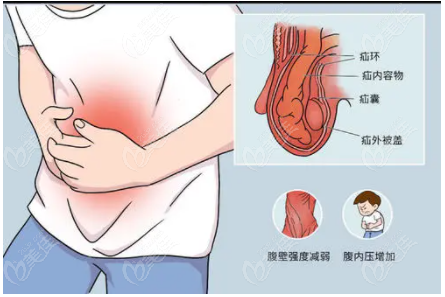 腹壁整形術(shù)到底有多痛呀