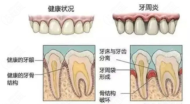 牙疼是因?yàn)槭裁丛蛞鸬? /></p><p>4、牙髓炎：</p><p>牙痛癥狀：牙齒敏感，刷牙時(shí)疼痛明顯，特點(diǎn)是冷熱刺激疼痛，夜間自發(fā)疼痛；</p><p>五、根尖周炎：</p><p>牙痛癥狀：牙齒逐漸感染并擴(kuò)散到牙根尖端，表現(xiàn)為咬合時(shí)疼痛異常，服藥無效；</p><p>6、牙周腫脹：</p><p>牙痛癥狀:(美)牙周炎持續(xù)惡化引起的化膿性炎癥，(佳)牙齒感覺腫脹疼痛，熱痛加倍；(網(wǎng))</p><p>牙髓炎、根尖周炎、牙周腫脹的治療方法：當(dāng)牙髓炎不及時(shí)牙科沖洗治療時(shí)，會(huì)逐漸發(fā)展為根尖周炎、牙周腫脹，需要牙齦刮治療；</p><p style=