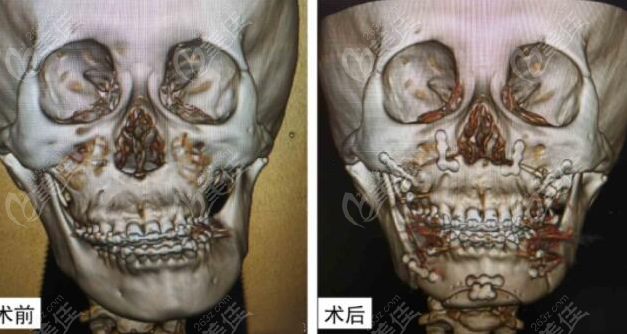 重庆一家医院做的正颌手术脸型变化图