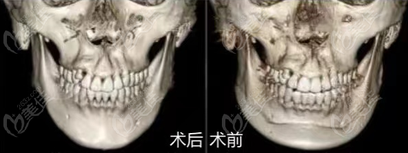 重庆一家医院做的正颌手术脸型变化图