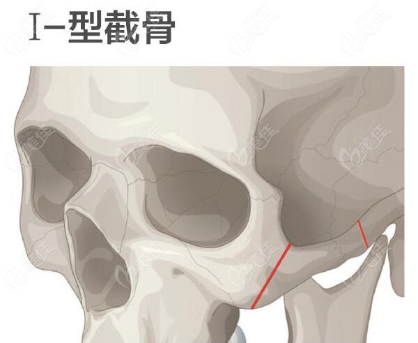 顴骨高做顴骨內(nèi)推手術(shù)選擇L型截骨和I型截骨哪種好