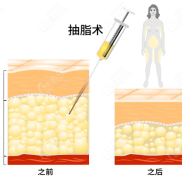 重慶軍美吸脂哪個(gè)醫(yī)生做得好