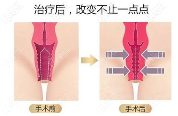 我做過(guò)3d生物束帶緊縮術(shù)兩年的親身經(jīng)歷