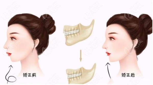 矯正牙齒對臉型變化的影響大嗎