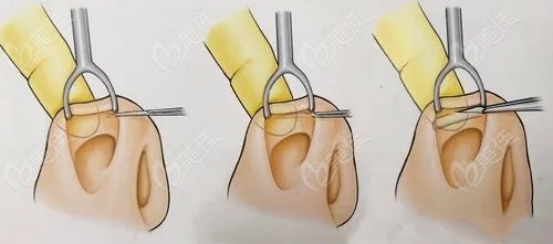 鼻翼緣退縮矯正手術(shù)難嗎