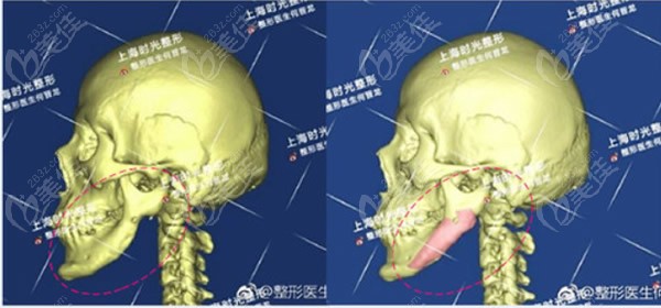 我下頜骨截骨后植骨的費用和真實感受