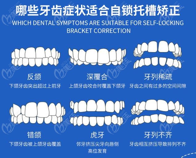 自鎖托槽有幾種類型