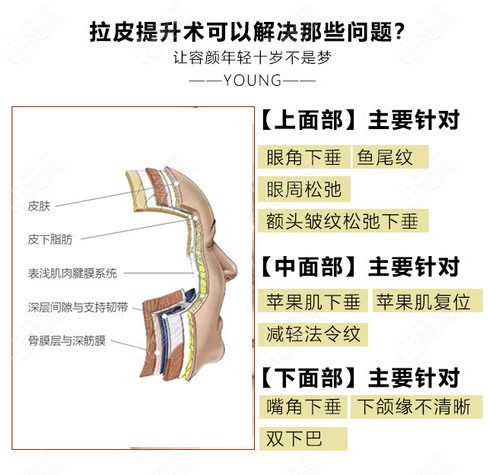 中下面部提升手術(shù)的切口在哪里