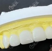 沈陽百嘉麗口腔做水晶牙貼面價格不貴
