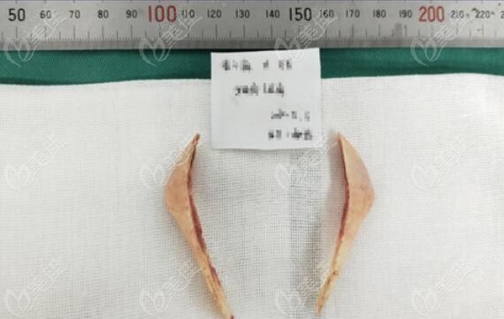 北京罗金超医生做下颌角磨骨脸不下垂