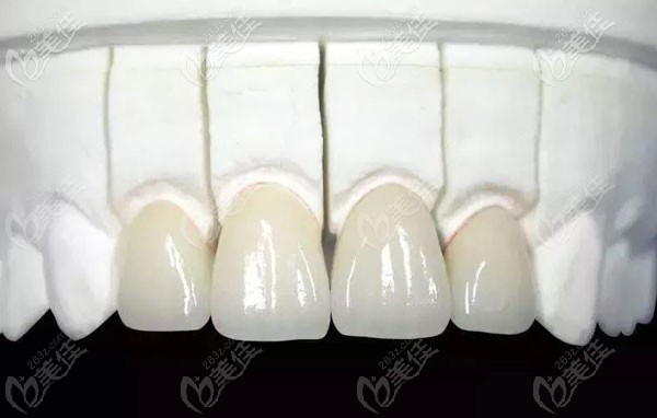 做全烤瓷牙带牙冠一定要磨左右两旁的牙齿吗