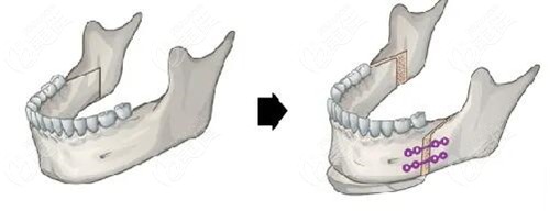 下颌后缩做正颌还是颏成型手术