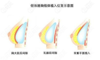 沈陽(yáng)做假體隆胸好的醫(yī)院推薦元辰醫(yī)美