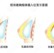 沈陽做假體隆胸好的醫(yī)院推薦元辰醫(yī)美