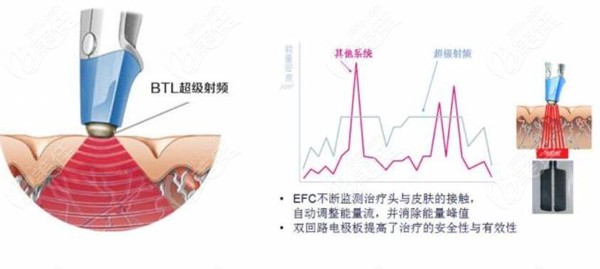 英國(guó)btl射頻和熱瑪吉哪個(gè)好