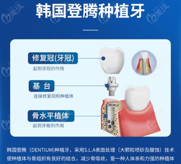 韩国ibs种植体怎么样