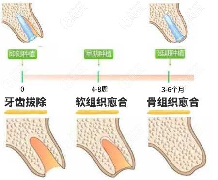 門牙為什么要即拔即種