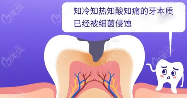 牙齒上的小黑洞會(huì)持續(xù)惡化