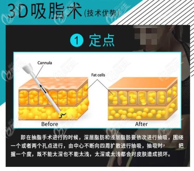 了解完mis吸脂術(shù)的原理和手術(shù)費(fèi)用