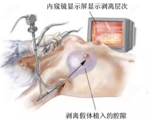 看网上说做内窥镜假体隆胸后24小时就能出院这是真的吗