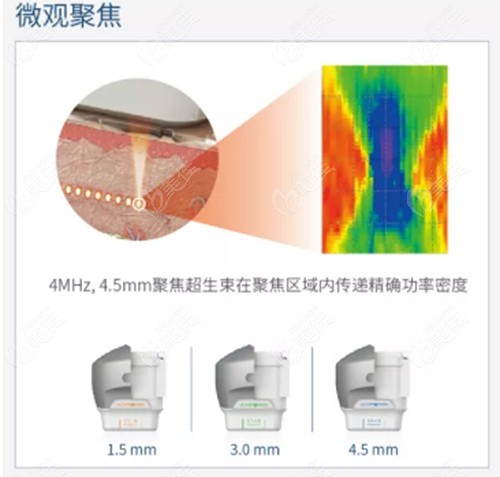 想真實感受下7d聚拉提操作過程中臉痛不痛