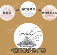 重慶李曉格醫(yī)生對(duì)唇腭裂修復(fù)手術(shù)在行不