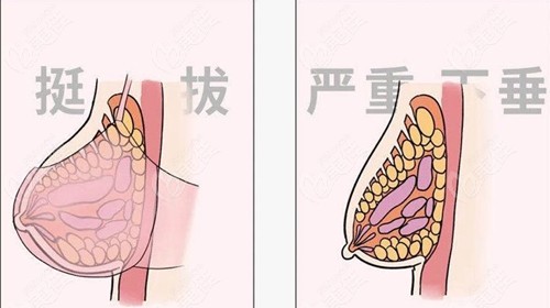 產(chǎn)后胸部韌帶撕裂下垂厲害做人工韌帶乳房提升能修復(fù)嗎