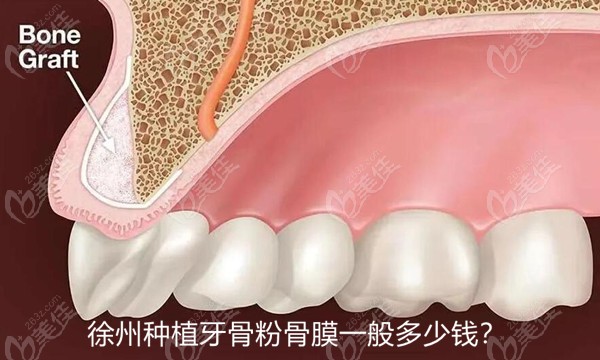 在徐州做种植牙填骨粉骨膜好一点的一般要多少钱