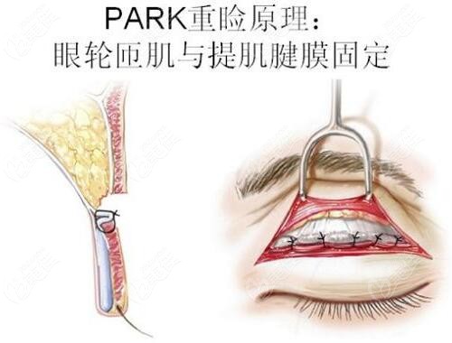 prak雙眼皮和kiss雙眼皮有什么區(qū)別