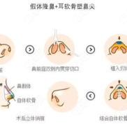 石家莊雅芳亞整形醫(yī)院做耳軟骨鼻綜合好嗎