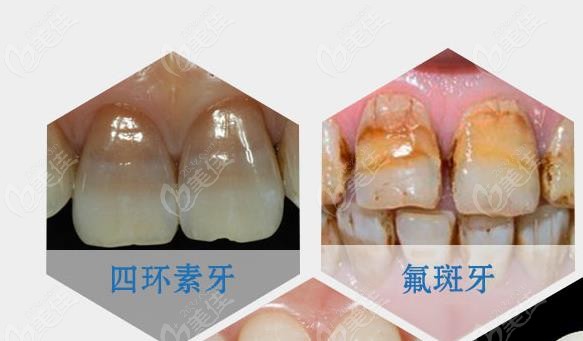 皓齿美白对四环素牙和氟斑牙有作用吗