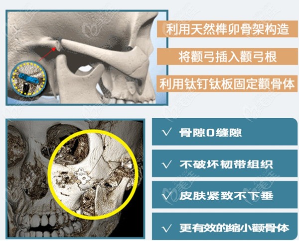 李運(yùn)峰醫(yī)生做顴骨顴弓內(nèi)推手術(shù)怎么樣