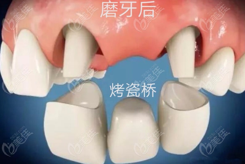 全口假牙的种类和价格解析