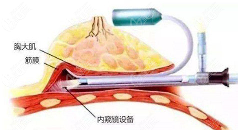 24小時(shí)假體豐胸術(shù)到底如何