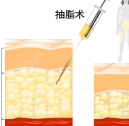 淄博抽脂整形醫(yī)院哪家好