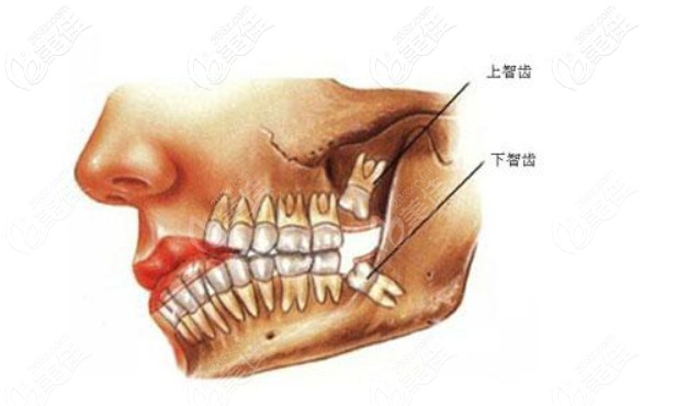 一次性拔4顆智齒會有危險嗎