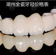 湖州全瓷牙冠價格表2024版已更新
