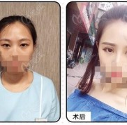 蘭州做去眼袋哪家醫(yī)院比較好