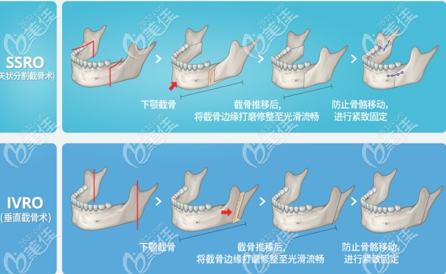 下顎骨突出矯正手術(shù)需要多少錢