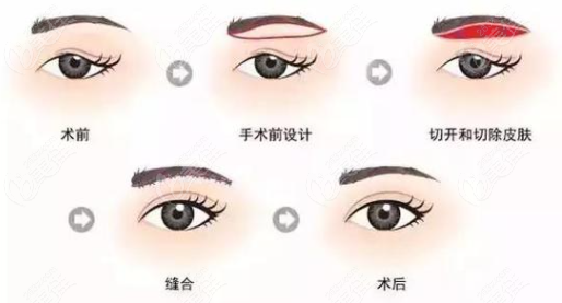 從切眉手術(shù)的三種切法來(lái)看