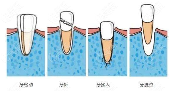 門牙受傷后牙齦鼓包怎么辦