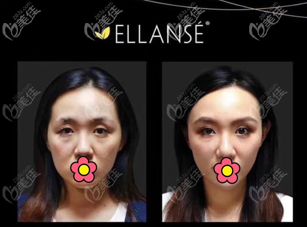 Ellanse洢莲丝少女针的价格和型号有关系吗