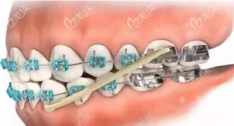 做牙齒矯正掛橡皮圈有啥用