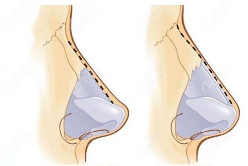 寬鼻做磨鼻骨和鼻骨內(nèi)推不一樣