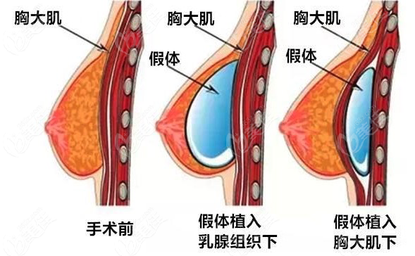 太瘦的人隆胸适合选那种假体呢