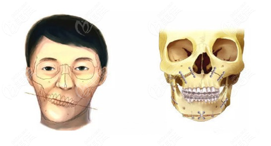 正頜手術復發(fā)和反彈怎么區(qū)別