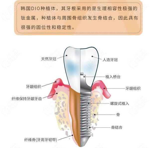 韩国dio迪奥种植体是由什么材质制作而成以及价格是多少钱都知道吗