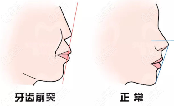 請問鼻基底凹陷